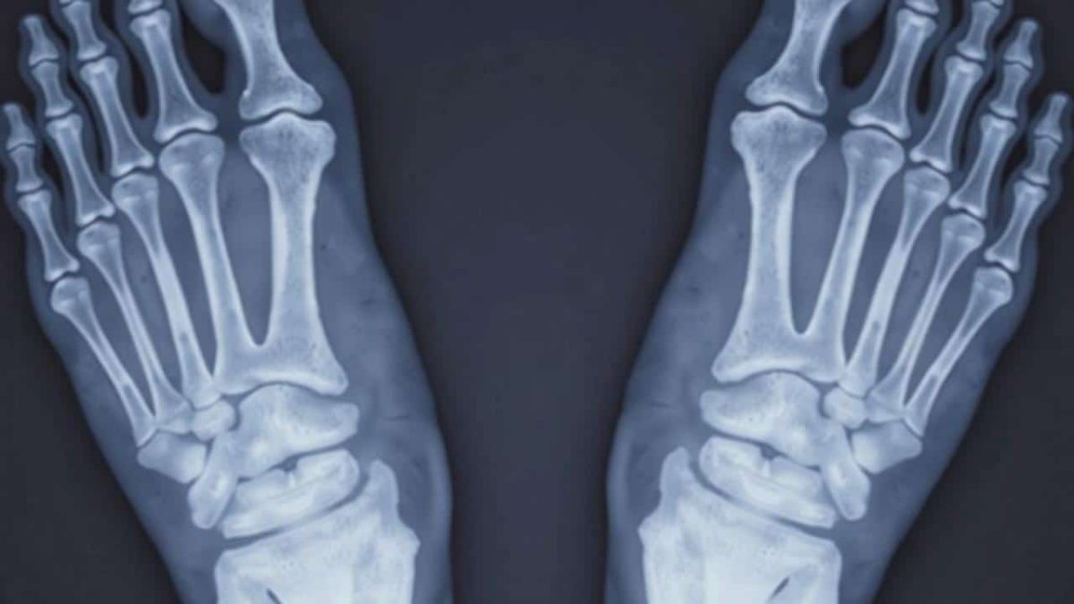 When shock waves help patients avoid orthopaedic surgery