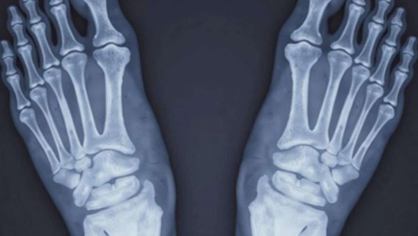 When shock waves help patients avoid orthopaedic surgery